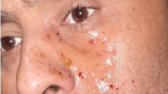 بسبب حملة فرعون.. محمود عبد المغني يتعرض للإصابة في وجهة